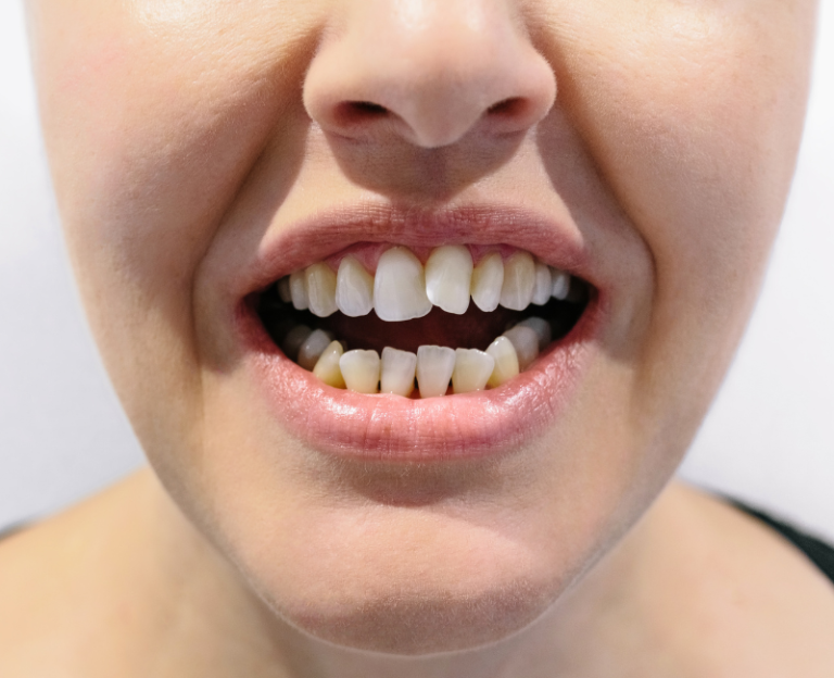 The Charming Quirk of Crooked Teeth: A Smile's Unique Signature ...